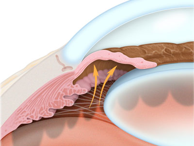 glaucoma-2